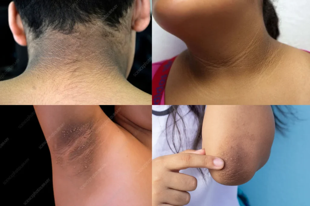 Ejemplos reales de acantosis nigricans en cuello, axilas y codos, una manifestación común de resistencia a la insulina.